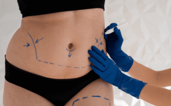 Non-surgical liposuction in Dubai