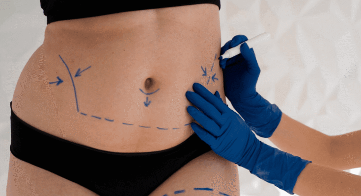 Non-surgical liposuction in Dubai