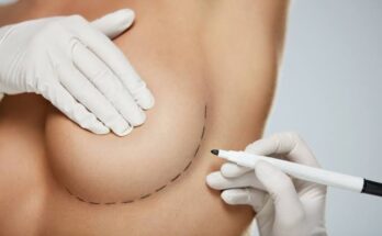Breast Augmentation in Dubai